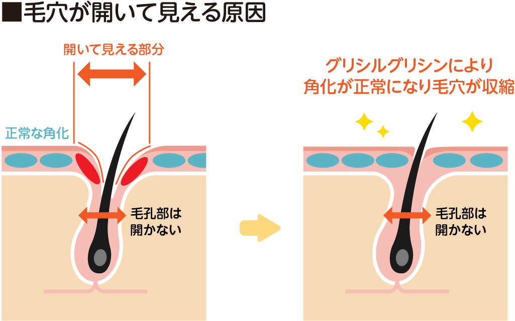 正常な角化を促し 毛穴の開きを改善する グリシルグリシン 美容医療のかかりつけ医 わたしの名医