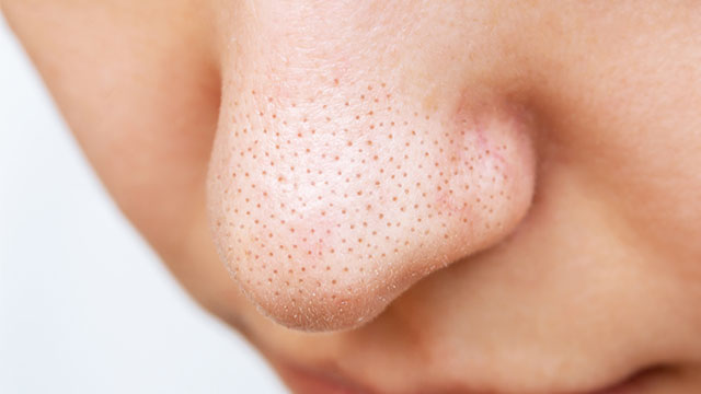 【医師監修】黒ずみの原因とは？小鼻、毛穴、お肌の気になるお手入れ方法を詳しく解説！