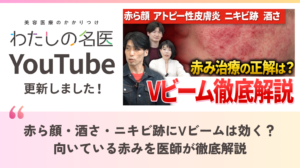 わたしの名医Youtube アルバアレルギークリニック札幌「赤ら顔・酒さ・ニキビ跡にVビームは効く？向いている赤みを医師が徹底解説」を公開いたしました。